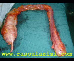 تصوير روده بزرگ مبتلا به کوليت اولسراتيو که از بدن بيمار به طور کامل خارج شده